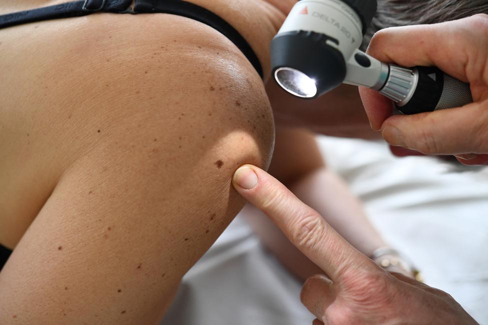 Un dermatologue examine des grains de beauté chez un patient, à Quimper, dans l’ouest de la France. (Image d'illustration)