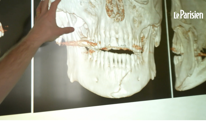 Accident trottinette