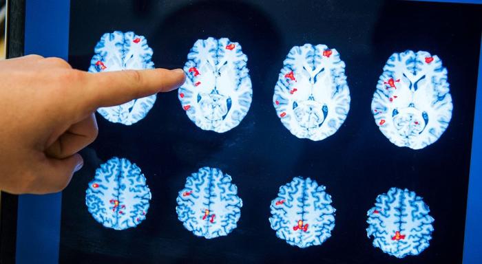 épilepsie cerveau AFP