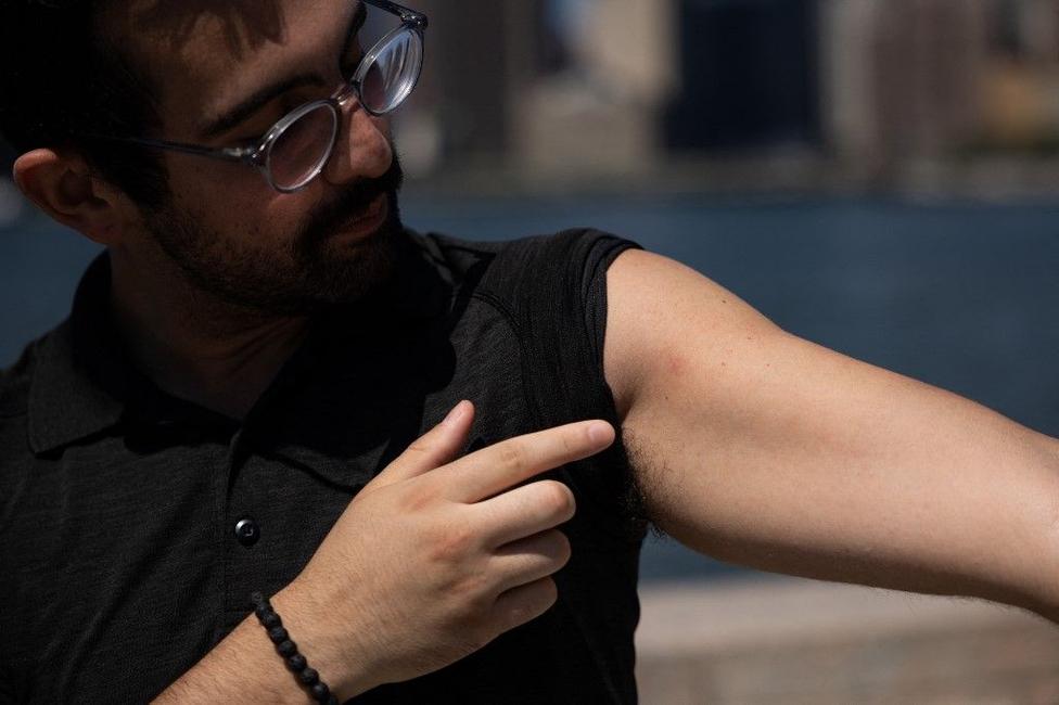 variole du singe AFP