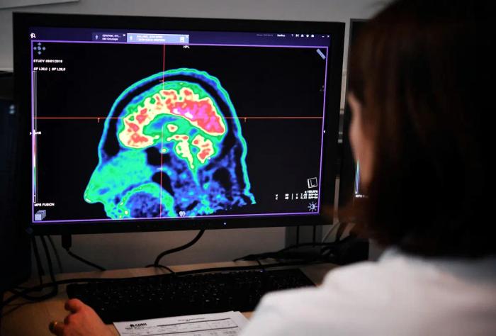 D’après l’OMS, 35,6 millions de personnes sont touchées par la maladie d’Alzheimer dans le monde