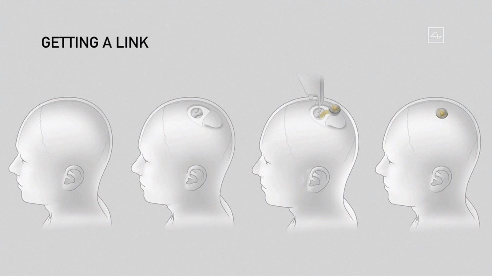 En 2025, de premiers résultats tangibles ont confirmé le potentiel des premières applications cliniques de Neuralink.