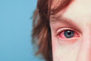 Yeux rouges