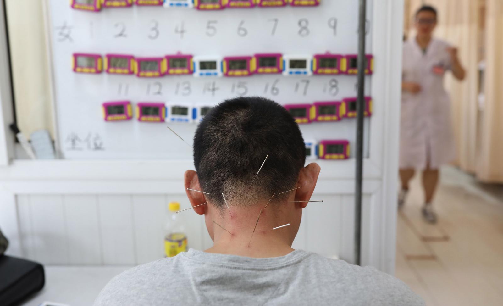 acupuncture Chine